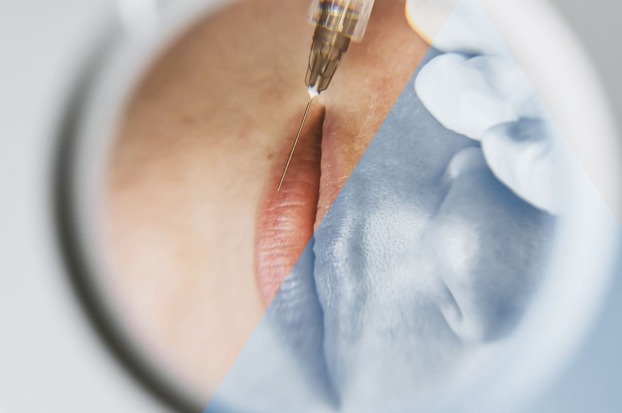 Medicina estetica trattamento viso